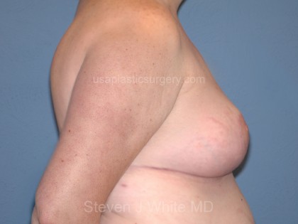 Breast Reduction Before & After Patient #3654