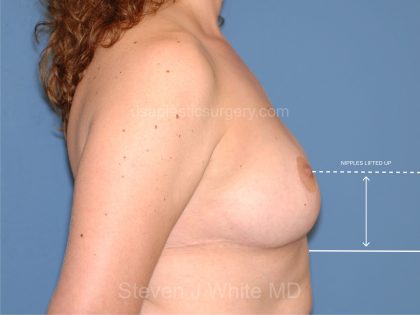Breast Reduction Before & After Patient #3508