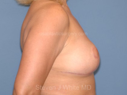 Breast Reduction Before & After Patient #3655