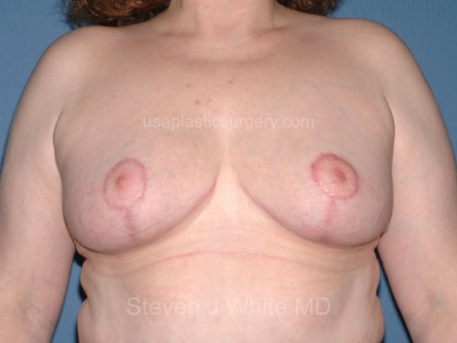 Breast Reduction Before & After Patient #3656