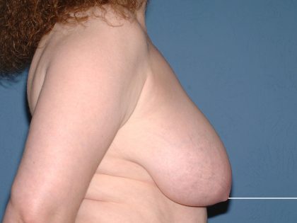 Breast Reduction Before & After Patient #3656