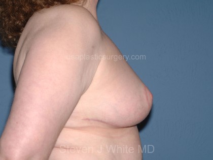 Breast Reduction Before & After Patient #3656