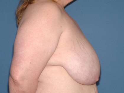 Breast Reduction Before & After Patient #3657