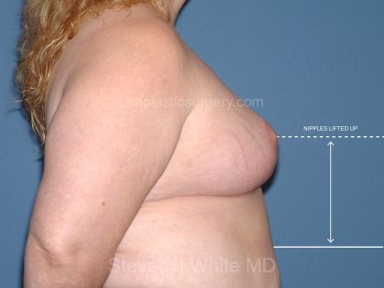 Breast Reduction Before & After Patient #3657