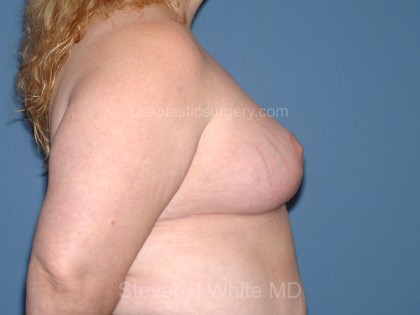 Breast Reduction Before & After Patient #3657