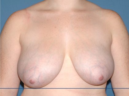 Breast Reduction Before & After Patient #3658