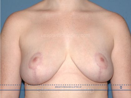 Breast Reduction Before & After Patient #3658