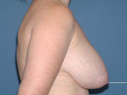 Breast Reduction Before & After Patient #3658