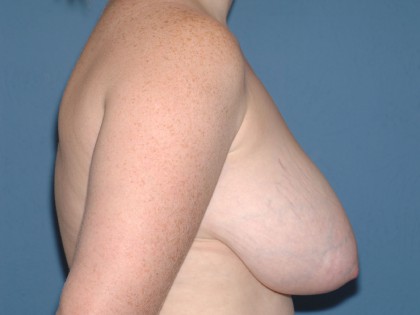 Breast Reduction Before & After Patient #3658