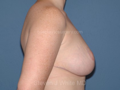Breast Reduction Before & After Patient #3658