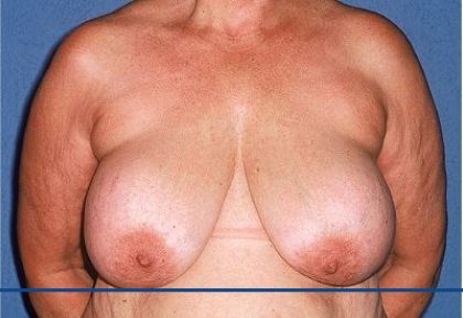 Breast Reduction Before & After Patient #3659