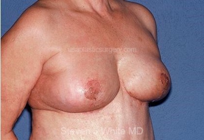 Breast Reduction Before & After Patient #3659