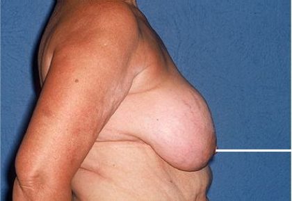 Breast Reduction Before & After Patient #3659