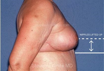 Breast Reduction Before & After Patient #3659