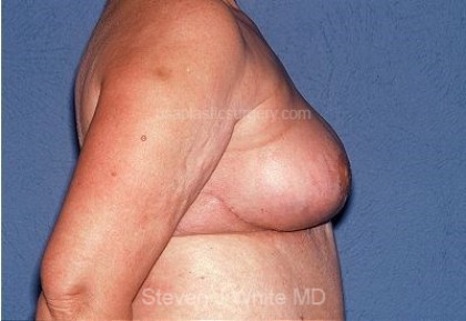 Breast Reduction Before & After Patient #3659