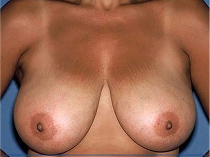 Breast Reduction Before & After Patient #3660