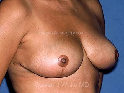 Breast Reduction Before & After Patient #3660