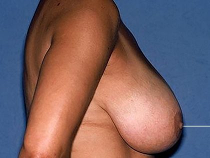 Breast Reduction Before & After Patient #3660