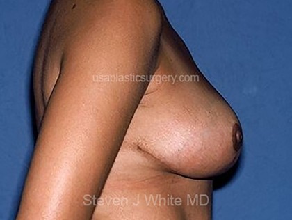 Breast Reduction Before & After Patient #3660