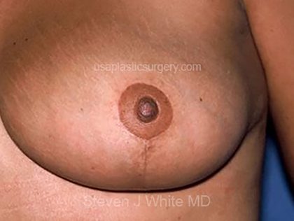 Breast Reduction Before & After Patient #3660