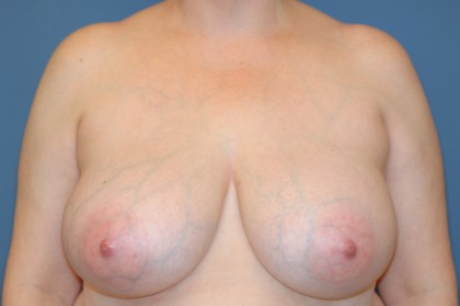 Breast Reduction Before & After Patient #3509