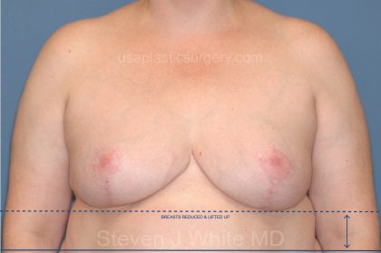 Breast Reduction Before & After Patient #3509