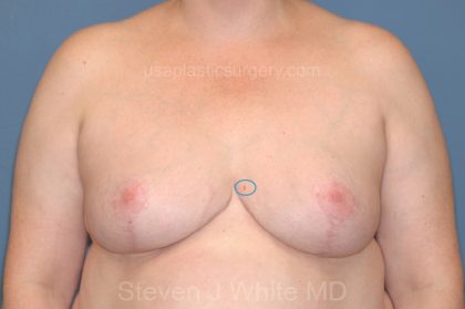 Breast Reduction Before & After Patient #3509