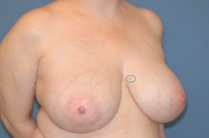 Breast Reduction Before & After Patient #3509
