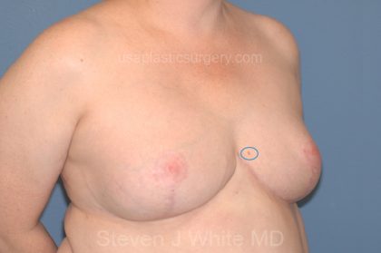 Breast Reduction Before & After Patient #3509