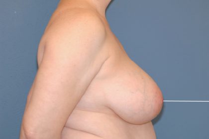 Breast Reduction Before & After Patient #3509
