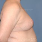 Breast Reduction Before & After Patient #3509