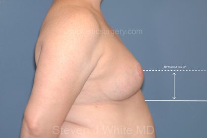 Breast Reduction Before & After Patient #3509