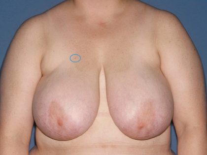 Breast Reduction Before & After Patient #3510