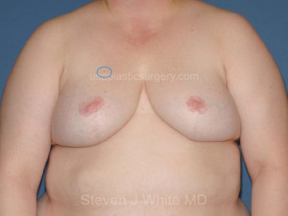 Breast Reduction Before & After Patient #3510