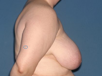 Breast Reduction Before & After Patient #3510