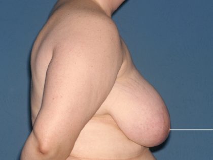 Breast Reduction Before & After Patient #3510
