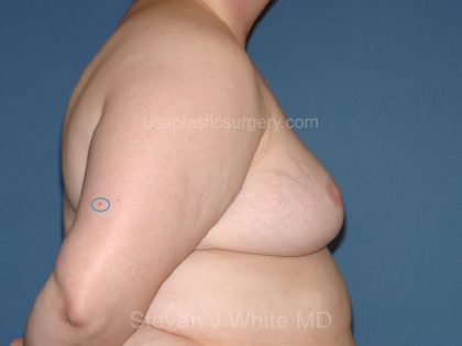 Breast Reduction Before & After Patient #3510