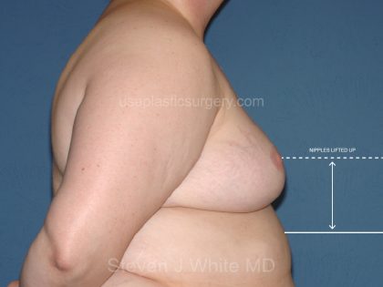 Breast Reduction Before & After Patient #3510