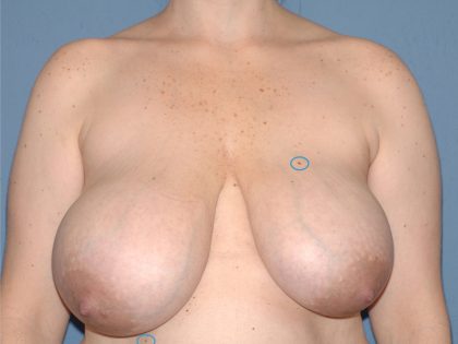 Breast Reduction Before & After Patient #3511