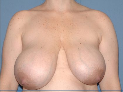 Breast Reduction Before & After Patient #3511