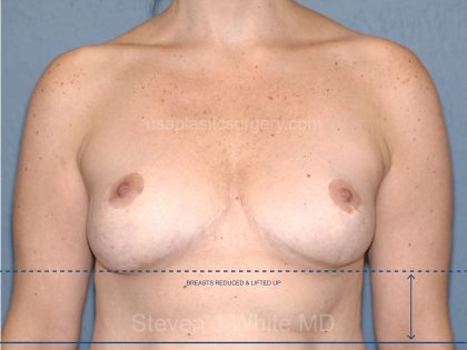 Breast Reduction Before & After Patient #3511