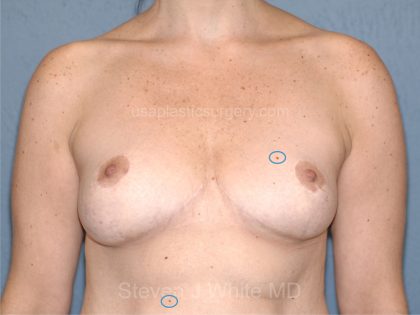 Breast Reduction Before & After Patient #3511