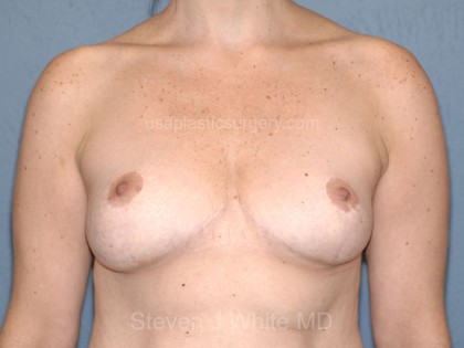 Breast Reduction Before & After Patient #3511