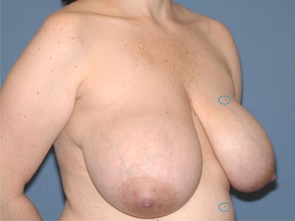 Breast Reduction Before & After Patient #3511