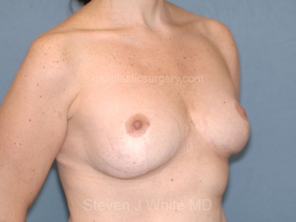 Breast Reduction Before & After Patient #3511