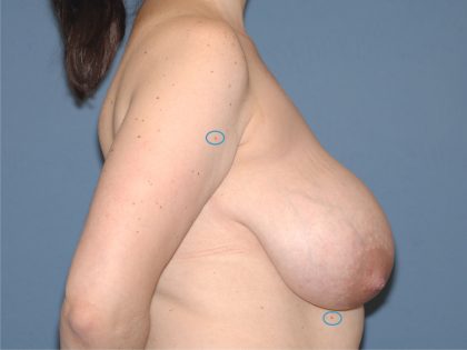 Breast Reduction Before & After Patient #3511