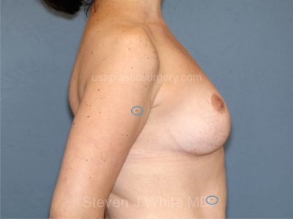 Breast Reduction Before & After Patient #3511