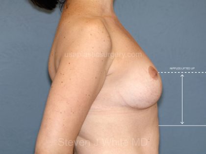 Breast Reduction Before & After Patient #3511