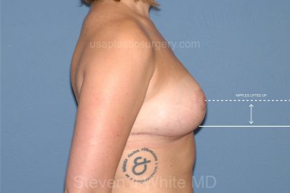 Breast Reduction Before & After Patient #3512