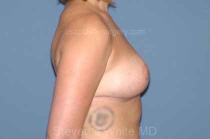 Breast Reduction Before & After Patient #3512